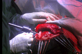 Brain surgery